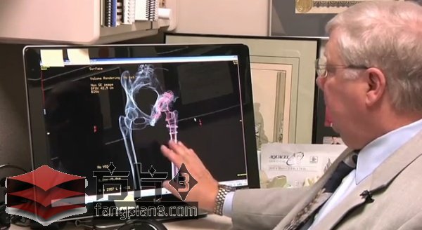 3D打印科技在臀部置换手术中的应用