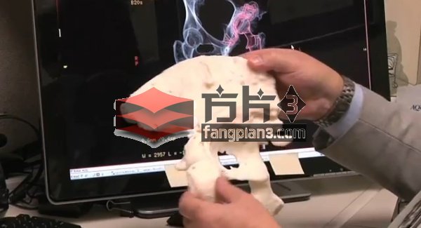 3D打印科技在臀部替换手术中的应用2
