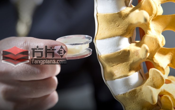 生物3D打印的椎间盘