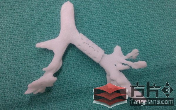 3D打印的气管支架