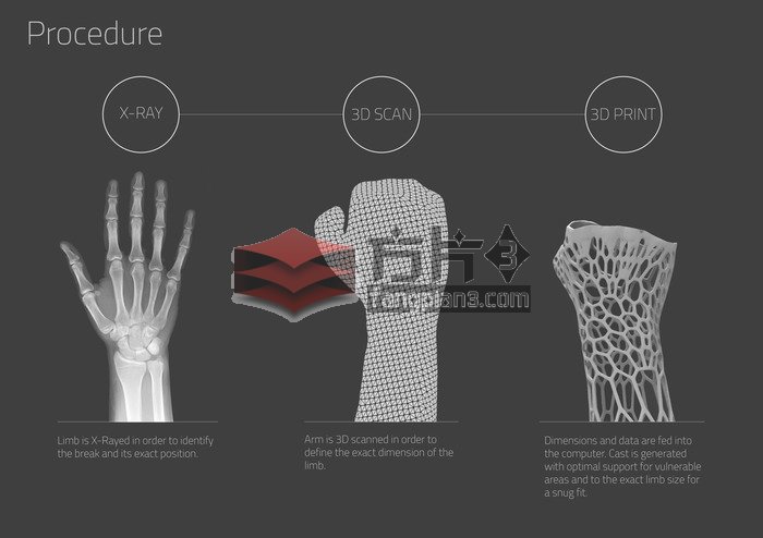 x光扫描-3D扫描-3D打印-骨骼固定器