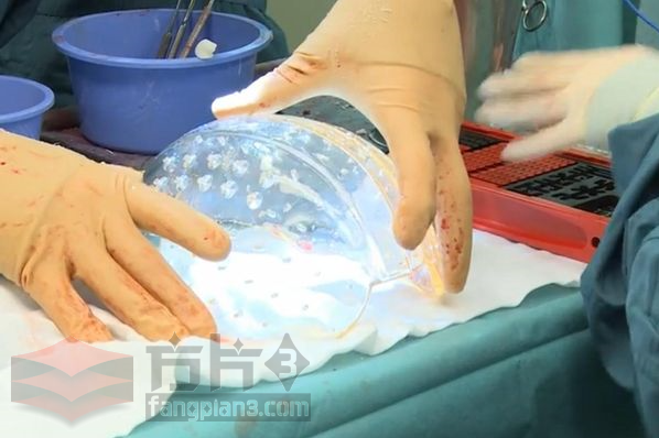 3D打印颅骨