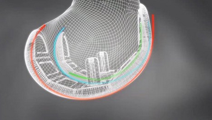 英国完成首例3D打印人造膝盖植入手术