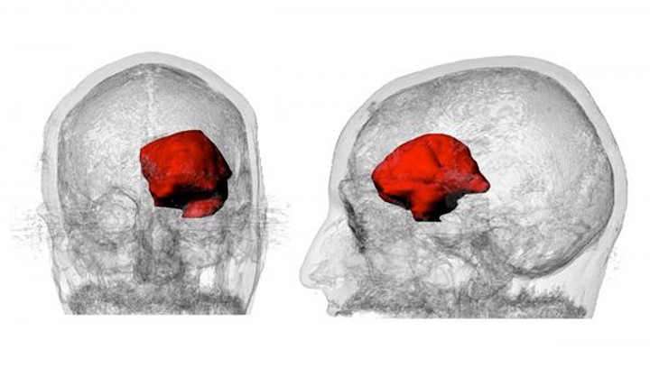 MIT博士借助3D打印迎击癌症分享病情