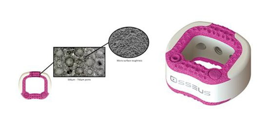 Osseus 3D打印颈椎植入物获得FDA 批准